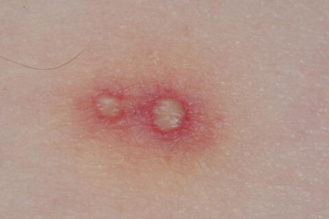 Closeup of two ant stings.